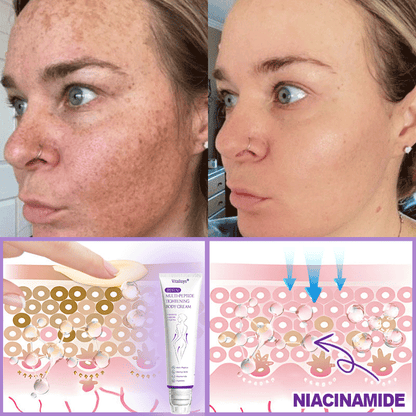 Vitalisys®💧PDRN Multi-Peptide Massaging Body Roller Cream- Anti-aging, Hydrating, Skin Firming & Lifting, Skin Repair, Even Tone, Acne and Dark Spot Treatment, Wart and Mole Removal, and Psoriasis Relief