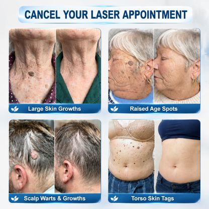 👩‍⚕️𝐇𝐈𝐒𝐊𝐈𝐍®👩‍⚕️ 𝟕-𝐃𝒂𝘆 𝐒𝗸𝐢𝐧 𝐓𝒂𝗴 & 𝐒𝐩𝙤𝐭 𝐄𝐫𝒂𝐬𝙚𝐫 Painless & Scar-Free Advanced Imperfection Removal Rollerball Pen
