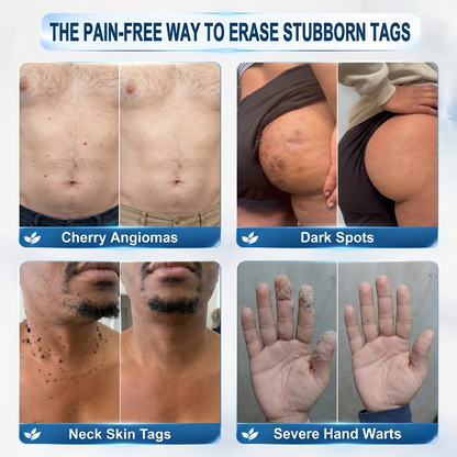 👩‍⚕️𝐇𝐈𝐒𝐊𝐈𝐍®👩‍⚕️ 𝟕-𝐃𝒂𝘆 𝐒𝗸𝐢𝐧 𝐓𝒂𝗴 & 𝐒𝐩𝙤𝐭 𝐄𝐫𝒂𝐬𝙚𝐫 Painless & Scar-Free Advanced Imperfection Removal Rollerball Pen