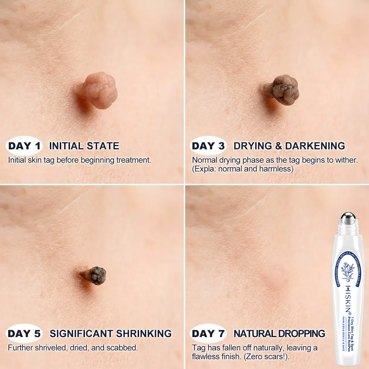 👩‍⚕️𝐇𝐈𝐒𝐊𝐈𝐍®👩‍⚕️ 𝟕-𝐃𝒂𝘆 𝐒𝗸𝐢𝐧 𝐓𝒂𝗴 & 𝐒𝐩𝙤𝐭 𝐄𝐫𝒂𝐬𝙚𝐫 Painless & Scar-Free Advanced Imperfection Removal Rollerball Pen