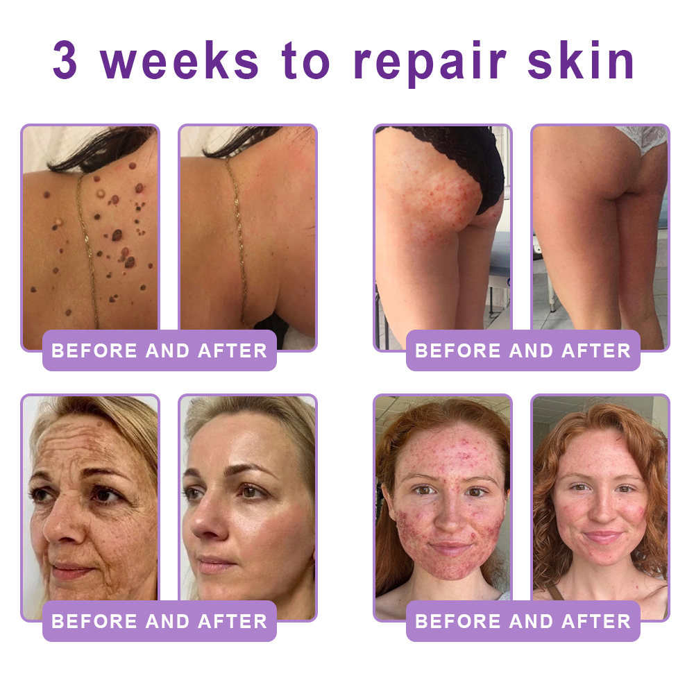 Vitalisys®💧PDRN Multi-Peptide Massaging Body Roller Cream- Anti-aging, Hydrating, Skin Firming & Lifting, Skin Repair, Even Tone, Acne and Dark Spot Treatment, Wart and Mole Removal, and Psoriasis Relief