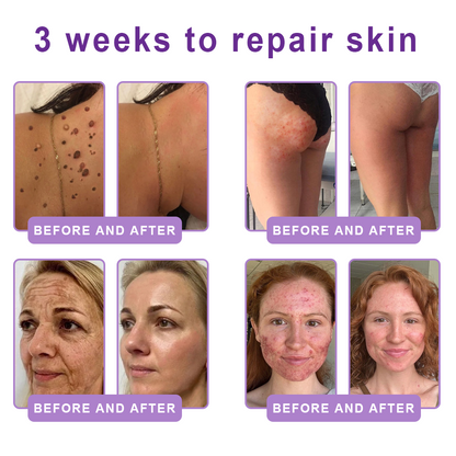 Vitalisys®💧PDRN Multi-Peptide Massaging Body Roller Cream- Anti-aging, Hydrating, Skin Firming & Lifting, Skin Repair, Even Tone, Acne and Dark Spot Treatment, Wart and Mole Removal, and Psoriasis Relief