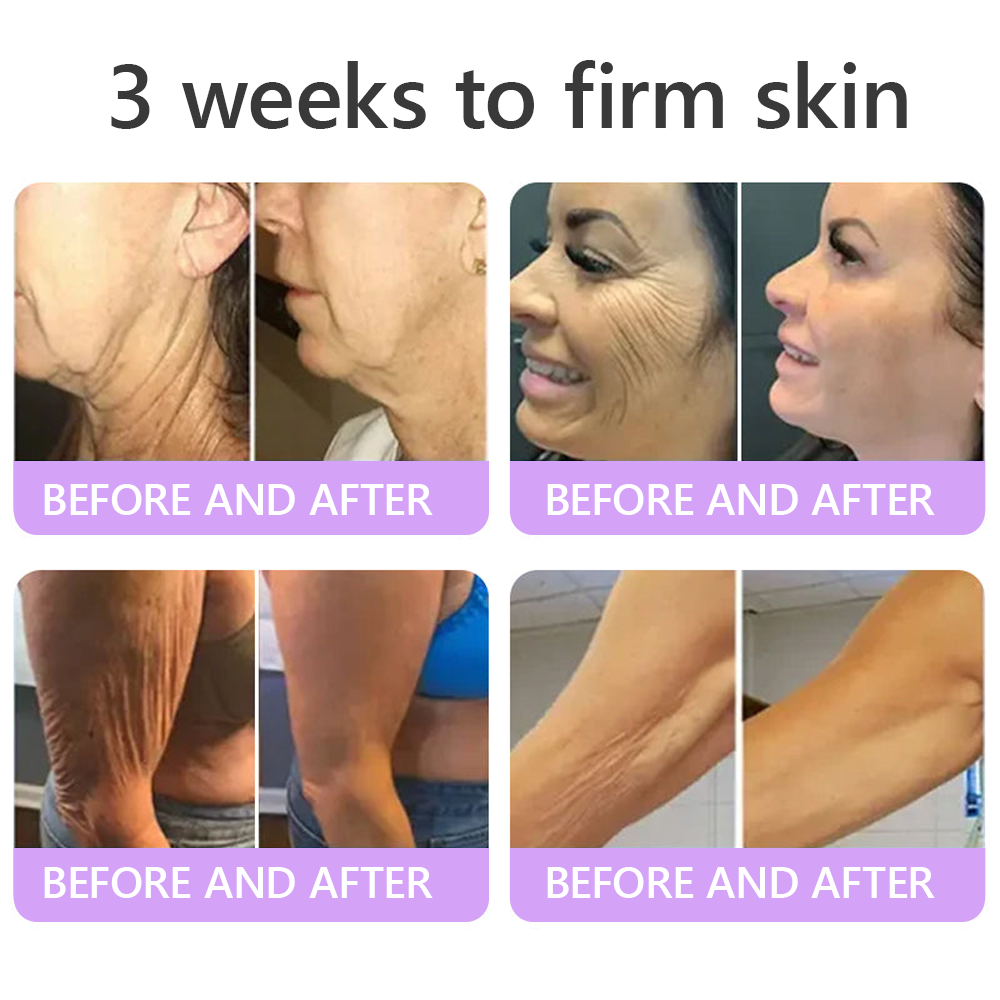 Vitalisys®💧PDRN Multi-Peptide Massaging Body Roller Cream- Anti-aging, Hydrating, Skin Firming & Lifting, Skin Repair, Even Tone, Acne and Dark Spot Treatment, Wart and Mole Removal, and Psoriasis Relief