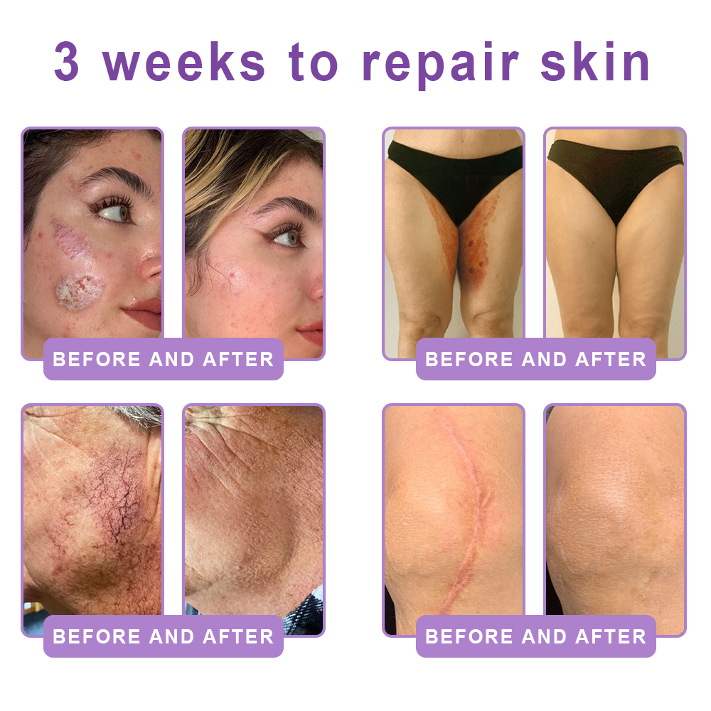 Vitalisys®💧PDRN Multi-Peptide Massaging Body Roller Cream- Anti-aging, Hydrating, Skin Firming & Lifting, Skin Repair, Even Tone, Acne and Dark Spot Treatment, Wart and Mole Removal, and Psoriasis Relief