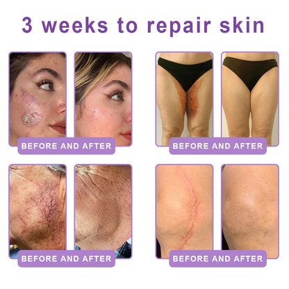Vitalisys®💧PDRN Multi-Peptide Massaging Body Roller Cream- Anti-aging, Hydrating, Skin Firming & Lifting, Skin Repair, Even Tone, Acne and Dark Spot Treatment, Wart and Mole Removal, and Psoriasis Relief